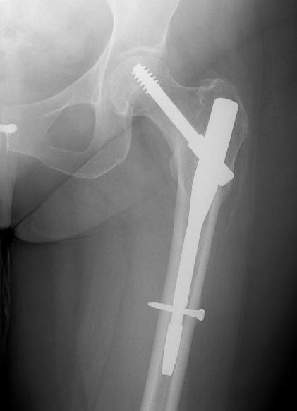 Sport related proximal femoral fractures: a retrospective review of 31  cases treated in an eight year period | British Journal of Sports Medicine